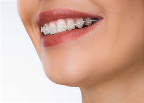 precio brackets metalicos vitaldent|que es un bracket metal.